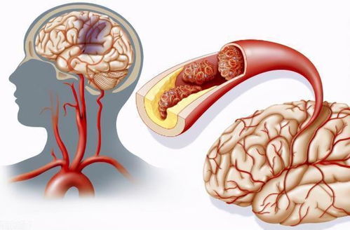 脑梗最新治疗方法，科技重塑生命之路的突破探索