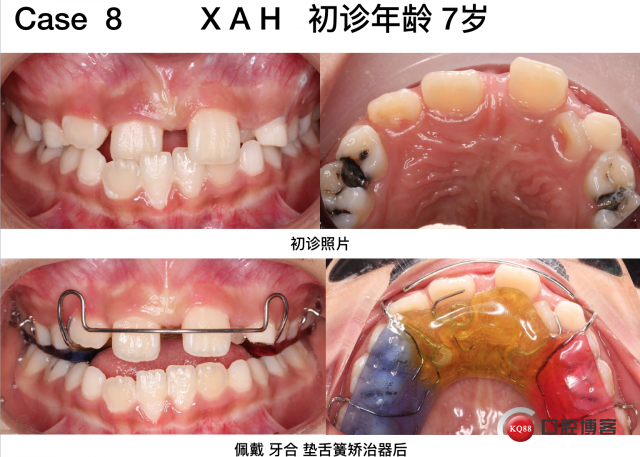 肘内翻最新矫正技术，探索与创新之路