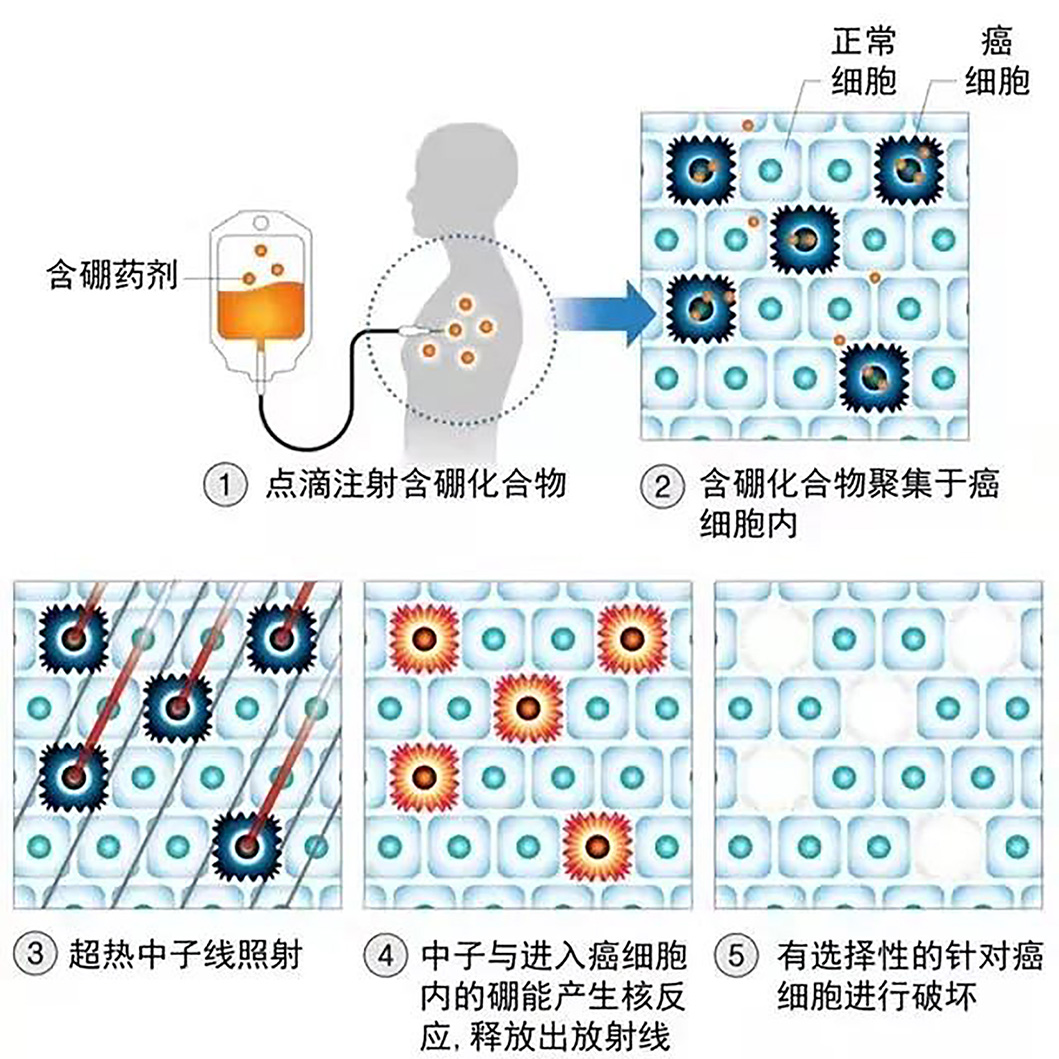 硼中子治疗最新进展与小巷特色小店的神秘面纱